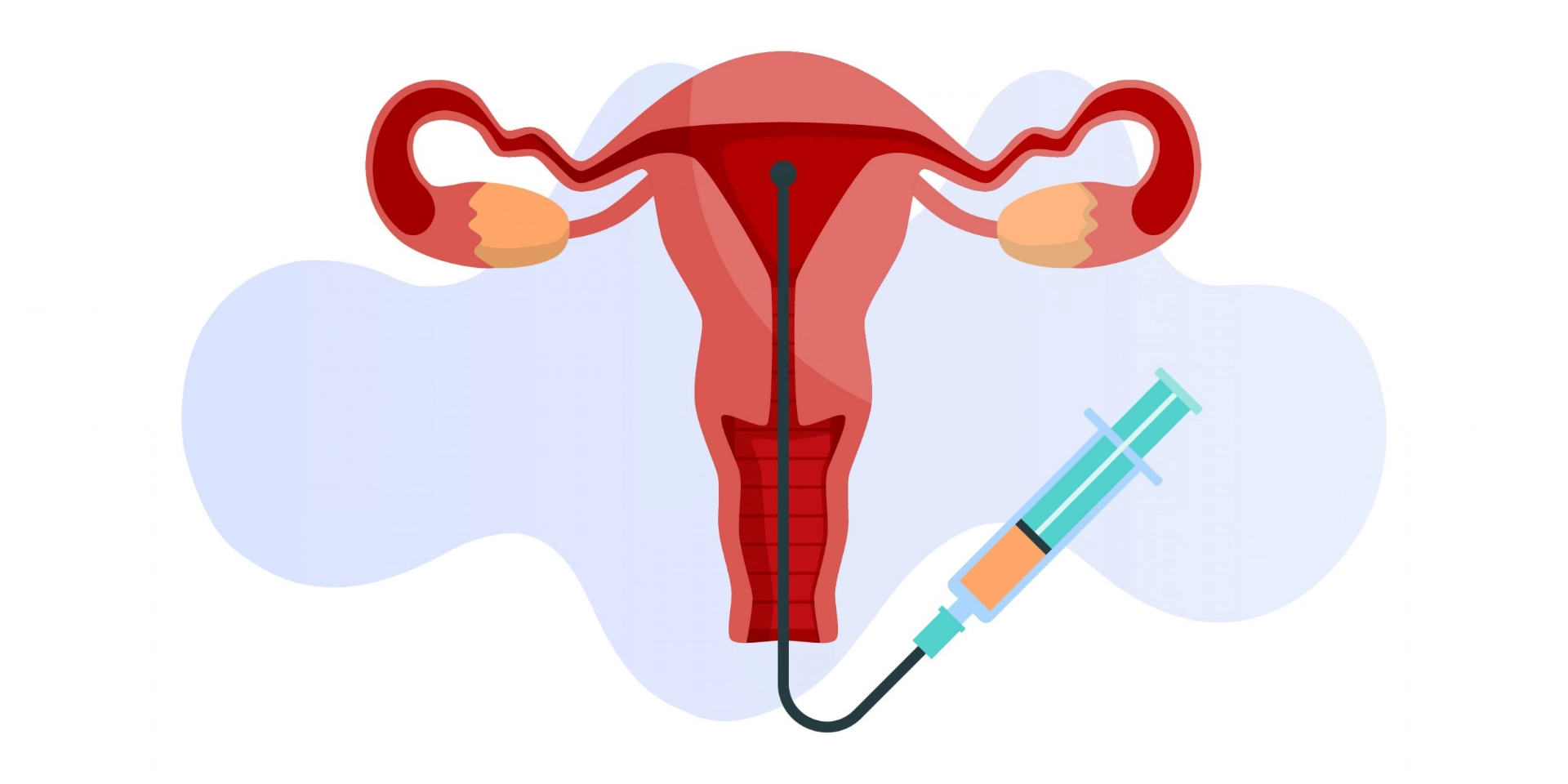 Insemination (IUI)