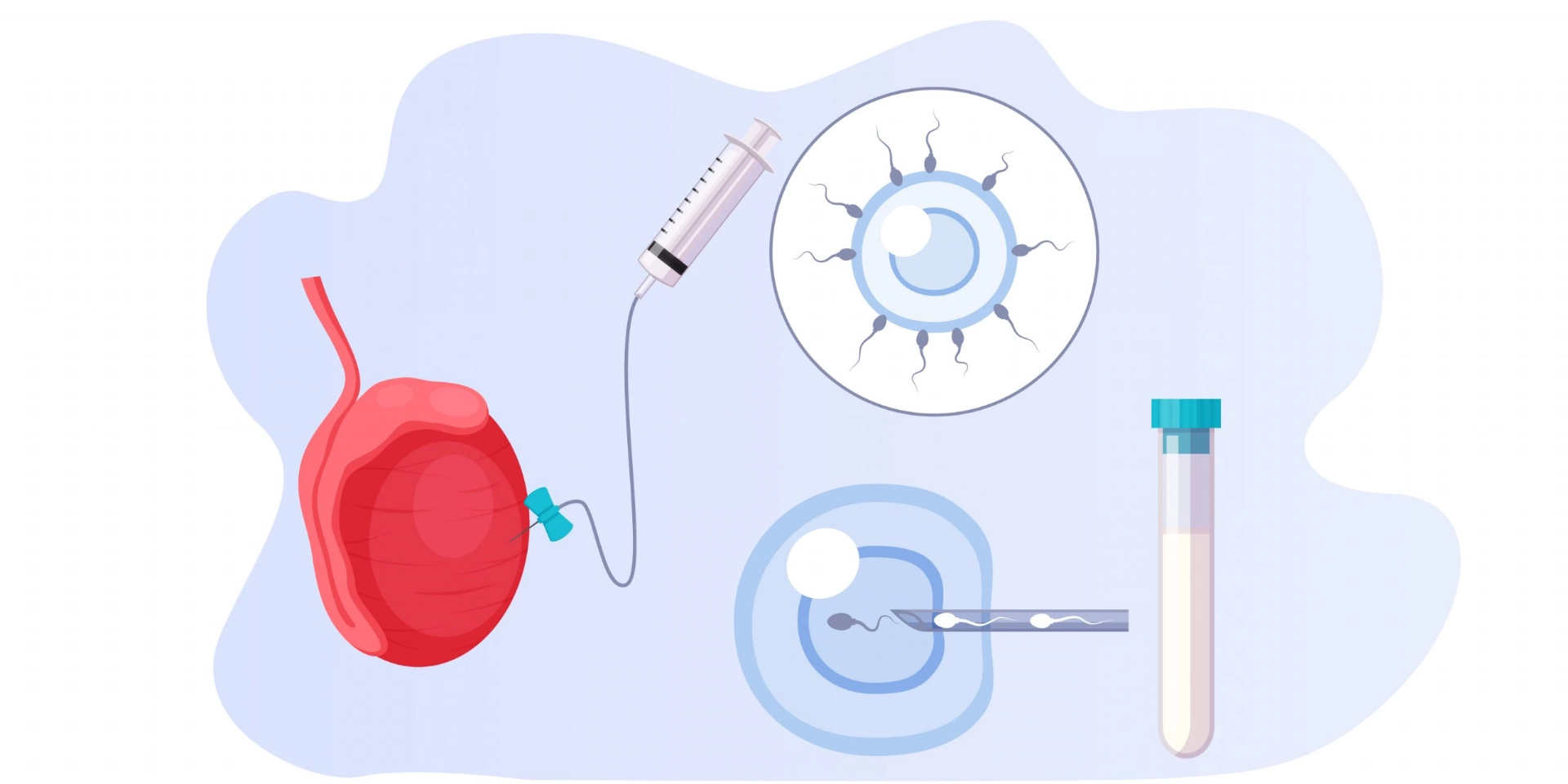 TESA/ TESE / Micro-TESE